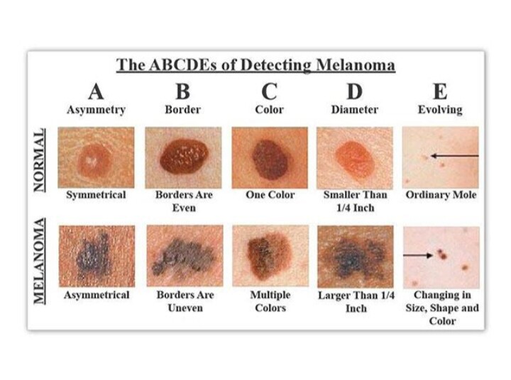 U susret danu borbe protiv malignog melanoma- ABCDE kriterijumi za otkrivanje malignog melanoma