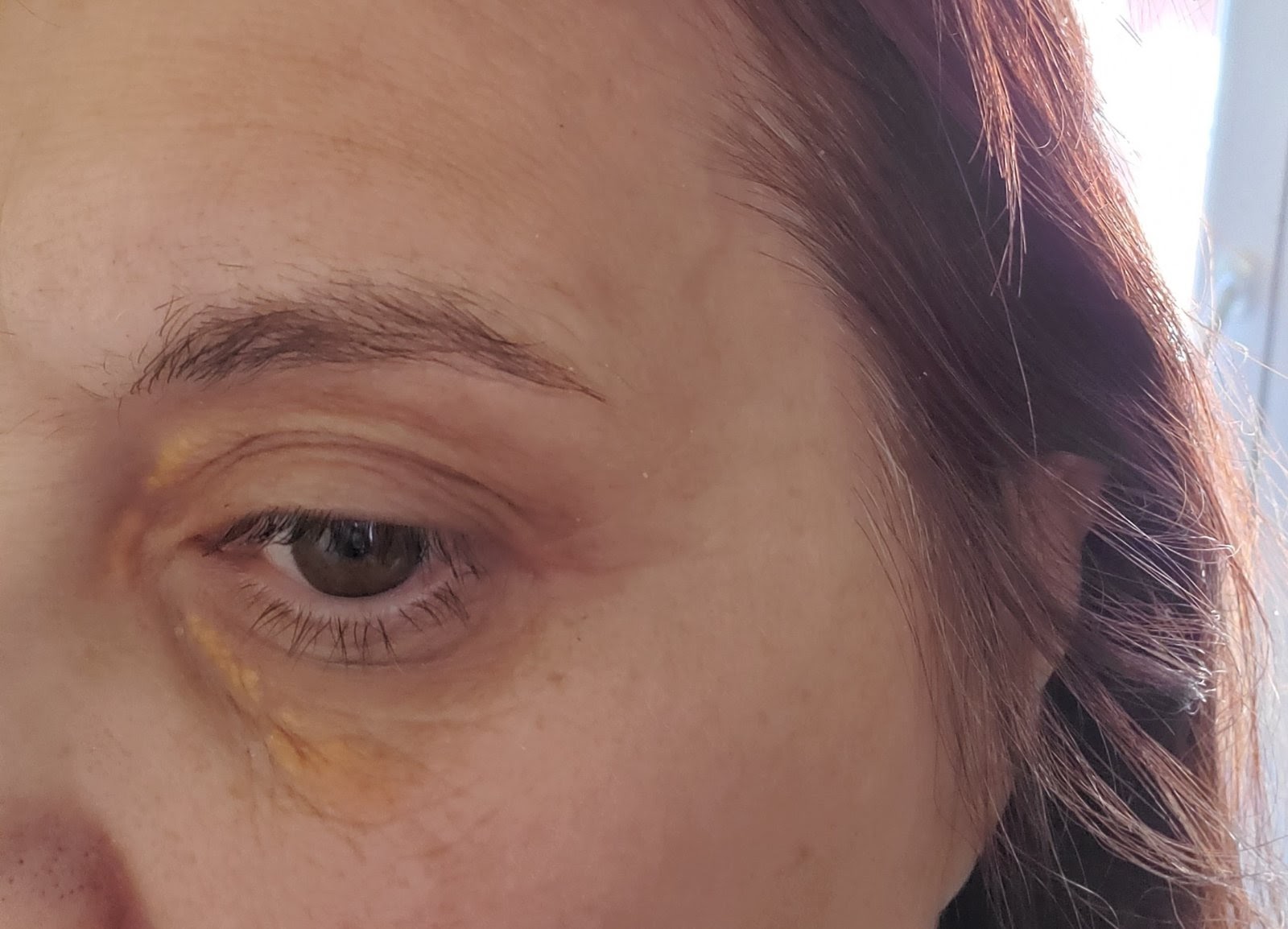 XANTHELASMA